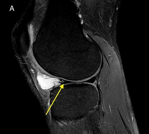 常见膝关节囊肿有哪些是否必须手术治疗会恶变吗医生告诉您