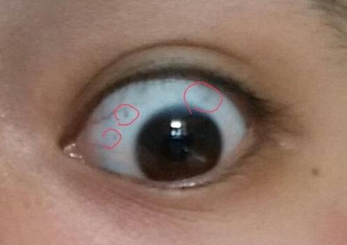 女童眼睛出现神秘黑点幕后黑手竟是奶奶买的哄娃神器