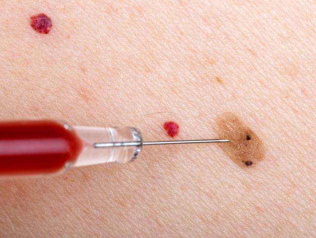 身上长出小红斑注意了可能不是皮肤问题或是肝发出的求救信号