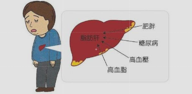 血脂高就会得脂肪肝吗