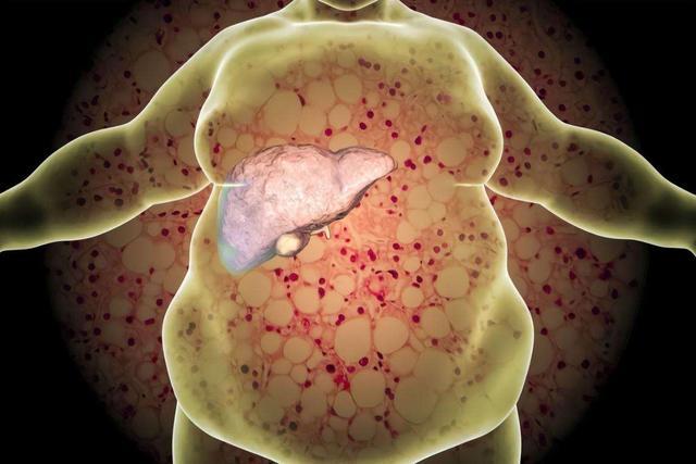 脂肪肝实图真实图片