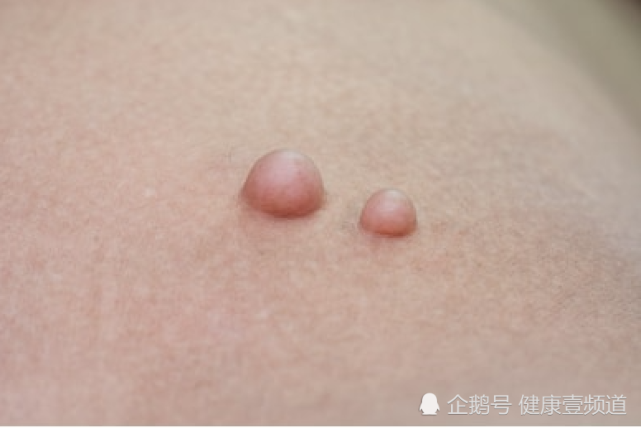松果体区脂肪瘤图片