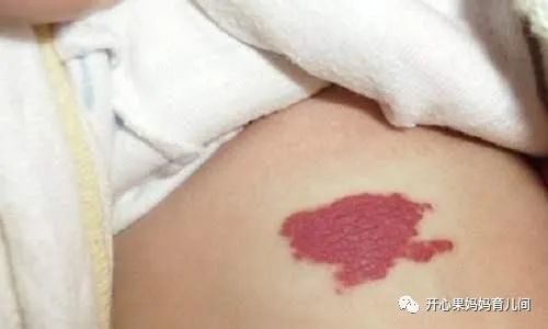 新生儿现橙红斑10个特殊异常父母要学会护理避免发育异常