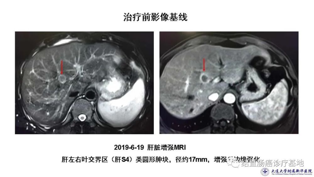 病例分享 直肠癌同时性肝转移合并肝门淋巴结转移转化治疗病例 腾讯新闻