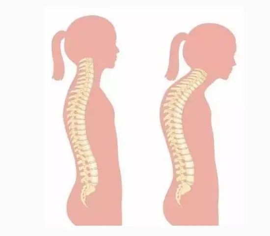 运动是防止驼背的好方法