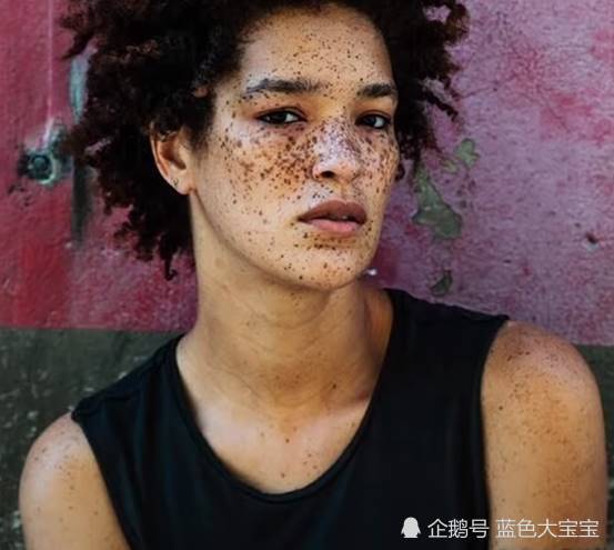 世界上5位拥有奇特皮肤的人类