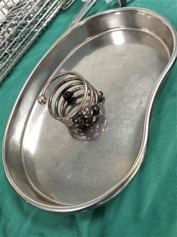 由于异物滞留时间太长,导致李某直肠感染,出现浓血症状,如果不及时