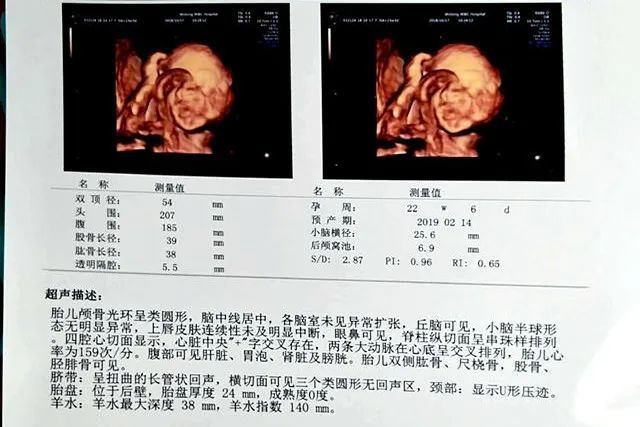 孕妈去做四维彩超被宝宝的模样丑到崩溃大哭还没出生就被嫌弃