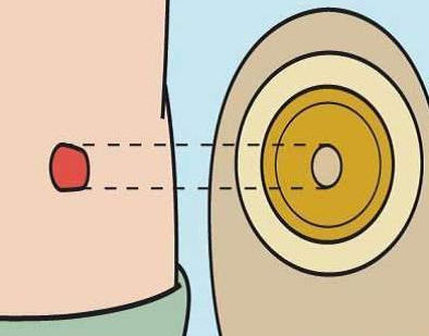 造口底盘的更换周期是多久