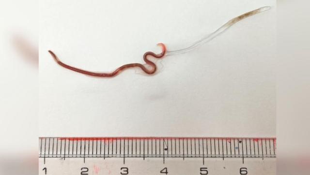 刺身|触目惊心！日本女吃刺身后喉咙刺痛，医生竟在其扁桃体内发现活虫