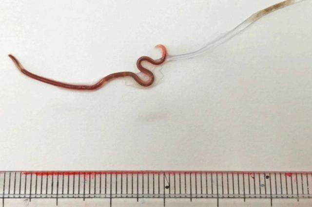 日本女子喉咙痛,去医院检查,结果从扁桃体里取出四厘米长的线虫