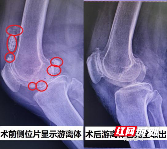 微创打洞巧捉关节鼠