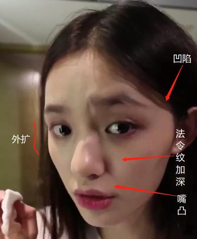 颧骨外扩太阳穴也凹陷,太多明星因此颜值骤降