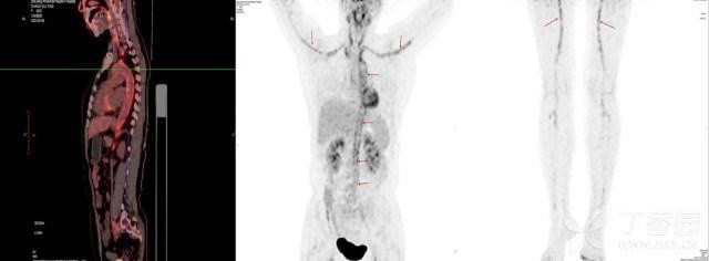 大动脉炎|中老年女性，发热伴头痛、乏力、消瘦，你知道病因是什么吗？