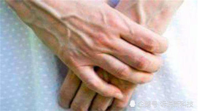 人的血液本是红色 为何手上血管却是青色 难道身体出问题了 血管 青筋