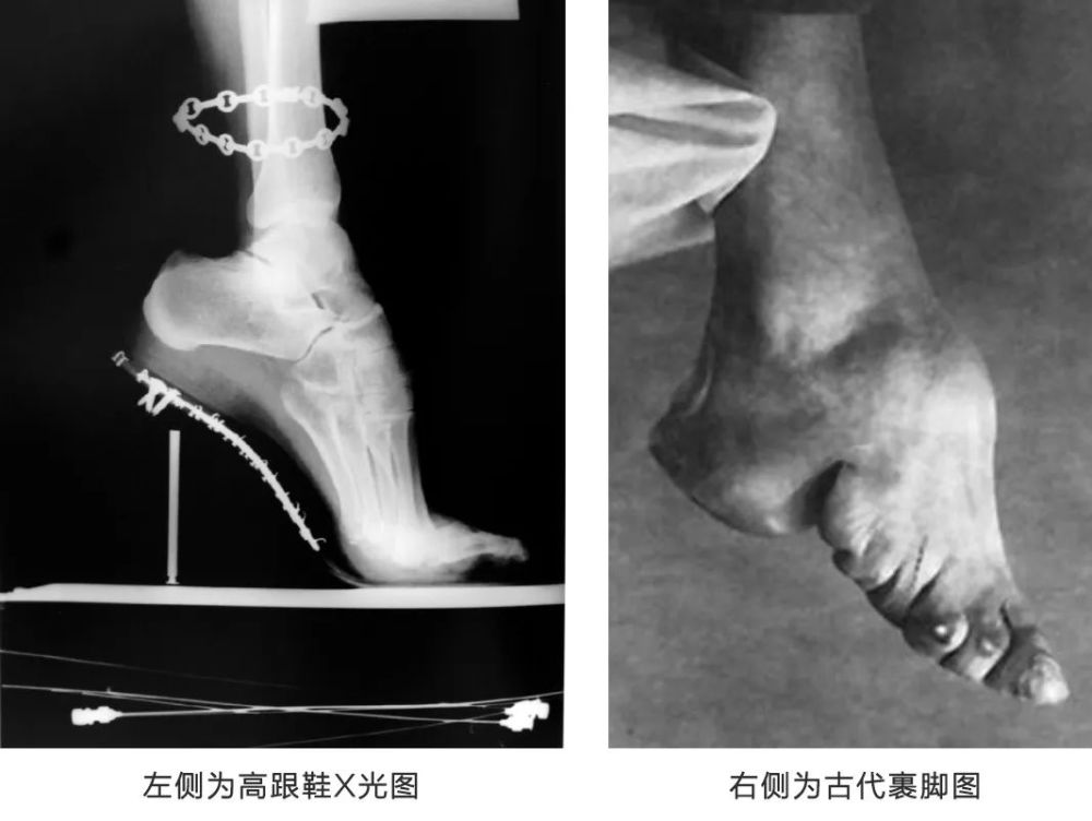 经常穿高跟鞋走路的女人,最后的样子,自己看了都害怕_腾讯新闻