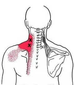肩酸背痛也许是肩胛提肌在发出信号