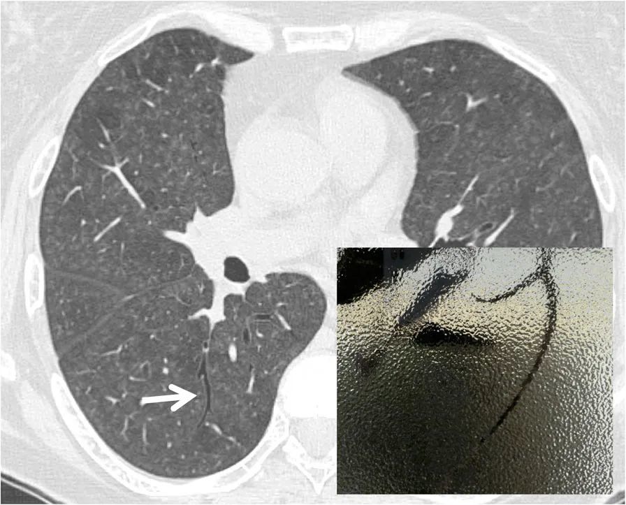 黑支气管征是指在肺实质中,由明显较暗的支气管构成的征象,呈磨玻璃样
