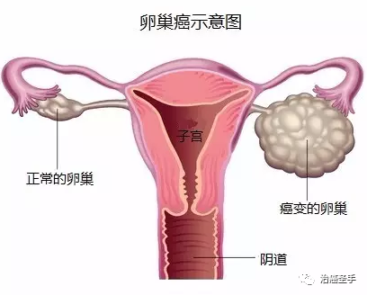 卵巢癌的中西医结合治愈经验 卵巢癌 中西医 肿瘤 癌症 生殖细胞肿瘤