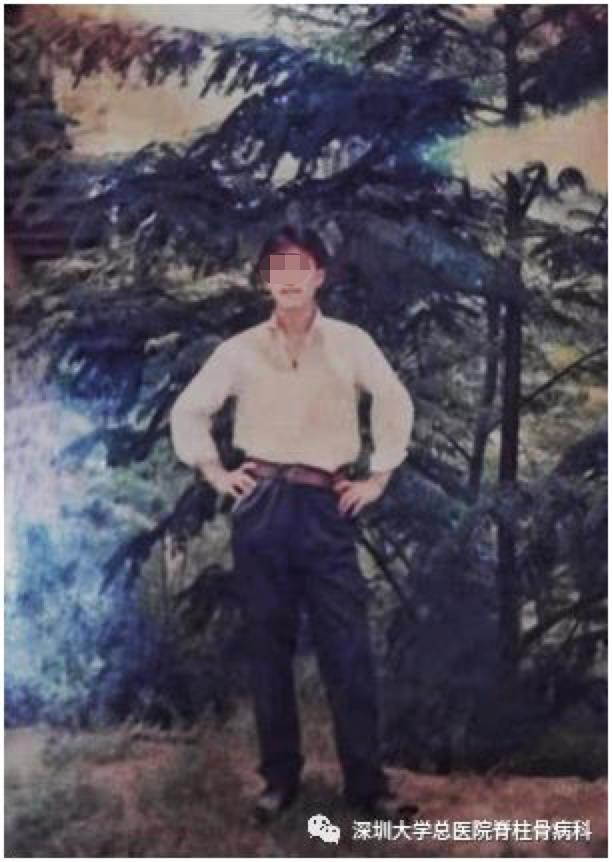 深圳大学总医院|身体被敲断四次重塑 国内首例“3-on折叠人”出院 想回老家开个小店