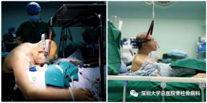 深圳大学总医院|身体被敲断四次重塑 国内首例“3-on折叠人”出院 想回老家开个小店