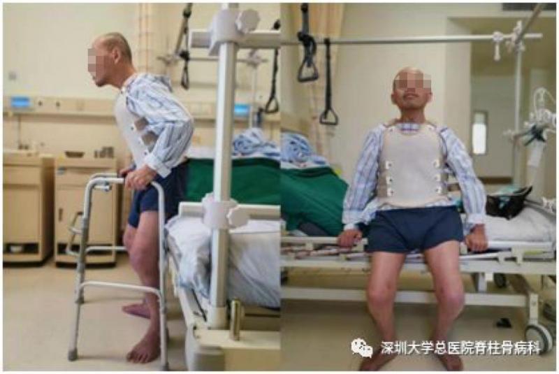 深圳大学总医院|身体被敲断四次重塑 国内首例“3-on折叠人”出院 想回老家开个小店