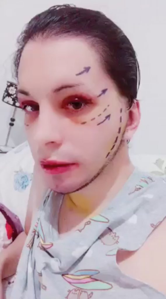 路易斯|男子从小受同学欺凌一心想变成精灵，如今已做了32次整容手术