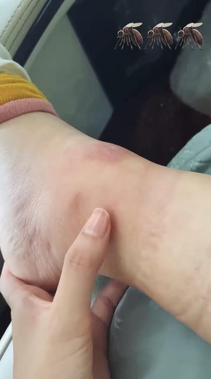 乔欣|乔欣象山拍戏被毒蚊子攻击，脚踝肿胀离谱，一按一个坑太夸张