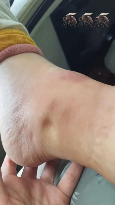 蚊虫叮咬导致脚踝肿胀图片