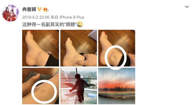 乔欣|乔欣象山拍戏被毒蚊子攻击，脚踝肿胀离谱，一按一个坑太夸张