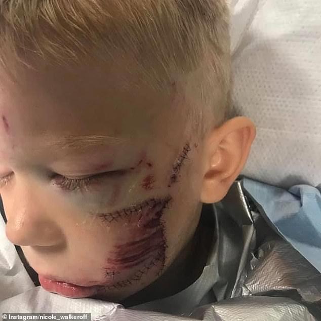 马克·鲁法洛|美“6岁硬汉大哥”为护妹妹血战恶狗，遭撕咬缝针90，坦言：只能我死