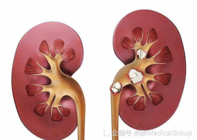 肾结石|午夜，宿舍里传来哀嚎声，原来是肾结石惹的祸