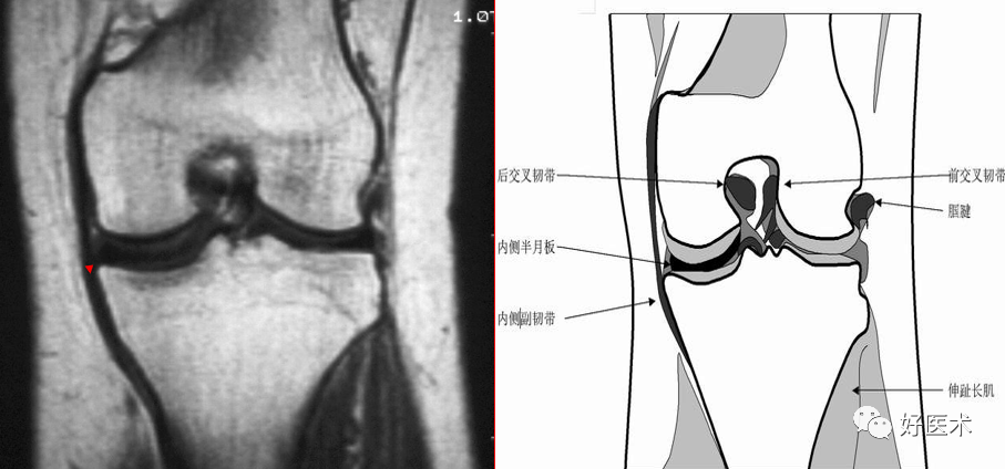 第一層外側副韌帶呈現清晰的低信號線樣結構,連接股骨外髁和腓骨小頭