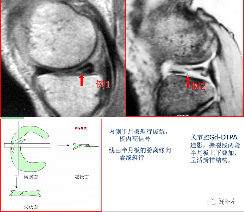 层层深入图文详解半月板mri解剖诊断 必备收藏贴 腾讯新闻