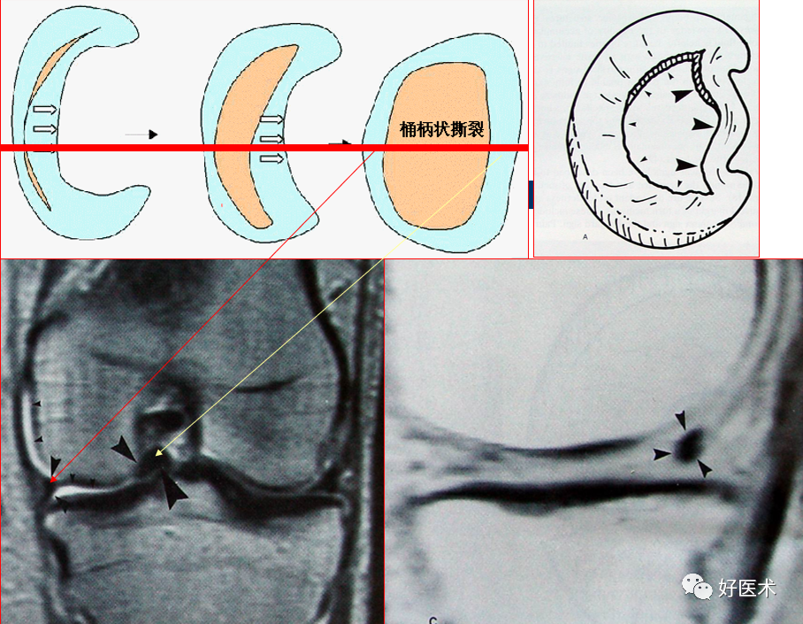 层层深入图文详解半月板mri解剖诊断,必备收藏贴!