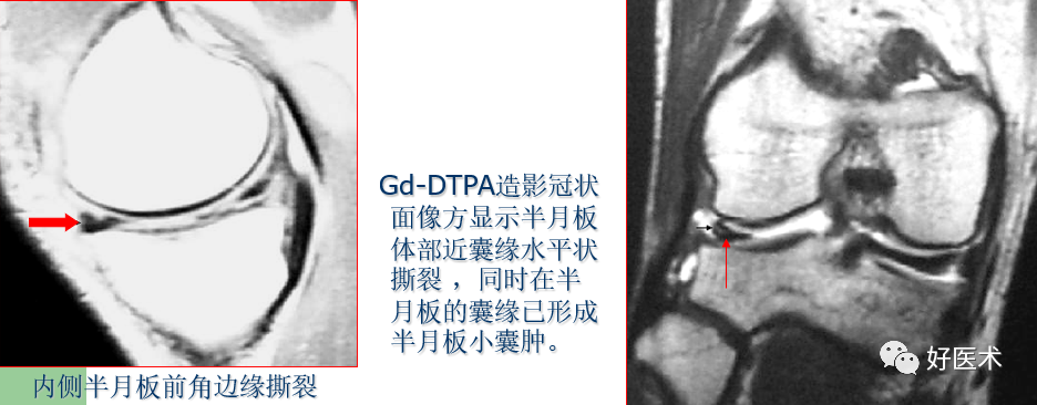 半月板解剖及损伤的详细图解 腾讯新闻