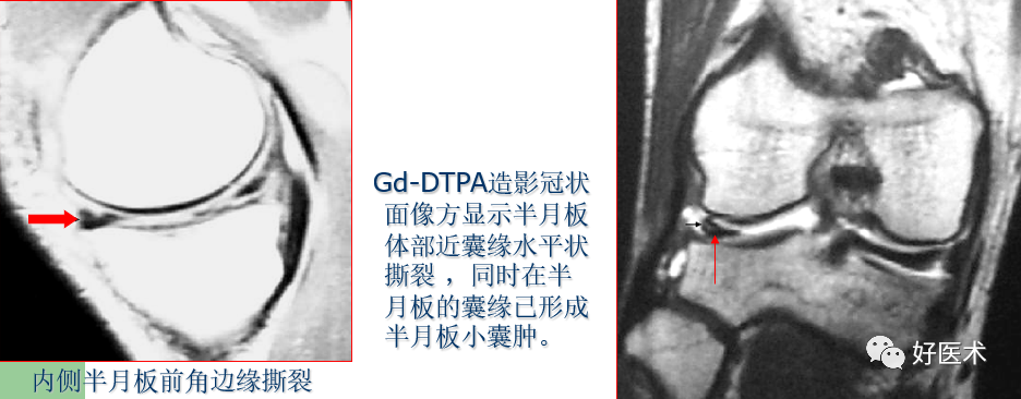 层层深入图文详解半月板mri解剖诊断 必备收藏贴 腾讯新闻