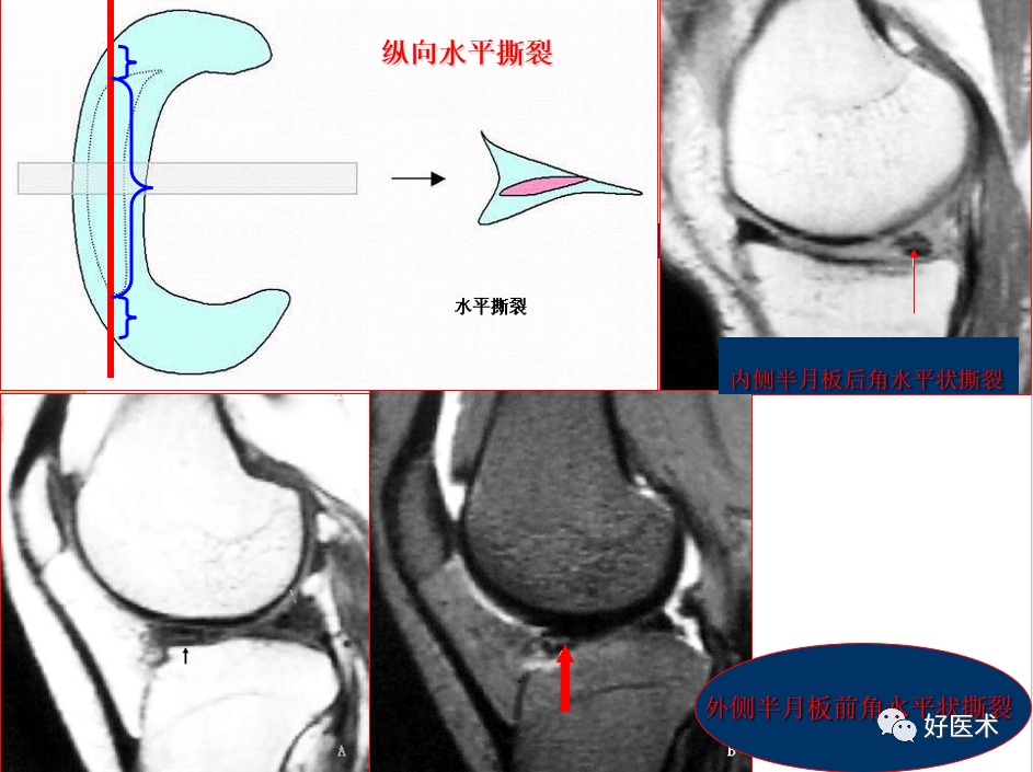 层层深入图文详解半月板mri解剖诊断 必备收藏贴 腾讯新闻