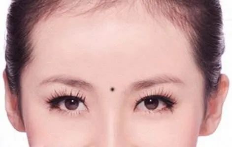 康博士告诉您眉间痣需要处理掉吗