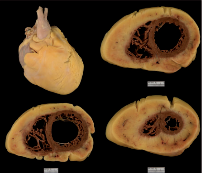 被脂肪覆盖的心,沉重的心