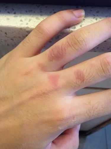 二度烫伤,皮肤有水泡和明显红肿.