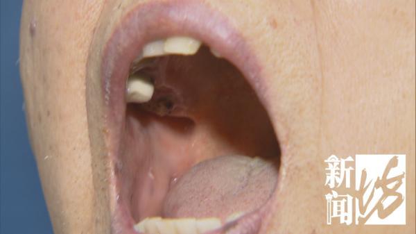 上海|大反转！上海知名餐厅“红烧肉里吃出的假牙”，原来是从他嘴里掉出来的