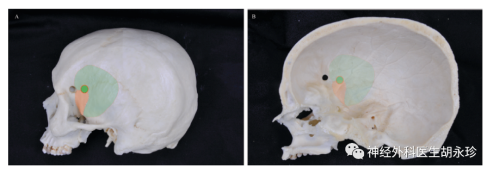 神经外科最常用的入路翼点入路