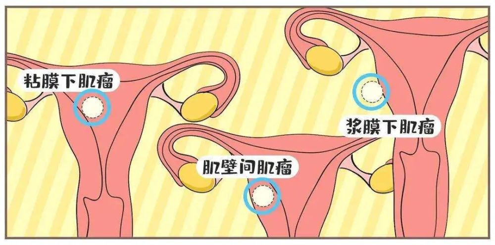 子宫肌瘤必须手术吗