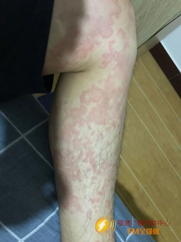 "我从未得过荨麻疹,也没有过敏史,前一天下午喝了星巴克的咖啡,晚上吃