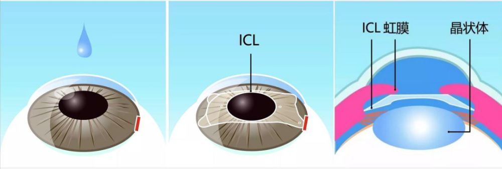 Icl术前术中术后常见问题科普 腾讯新闻