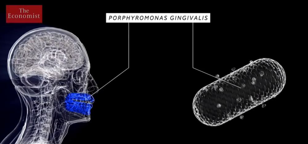 老年痴呆症|老年痴呆有多难治？美国总统也躲不过，几千亿美元打了水漂