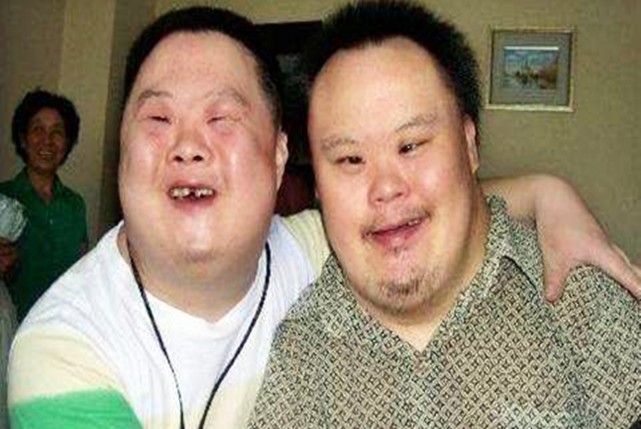 断掌是唐氏儿的表现两处体貌特征暗示患病预防从怀孕抓起