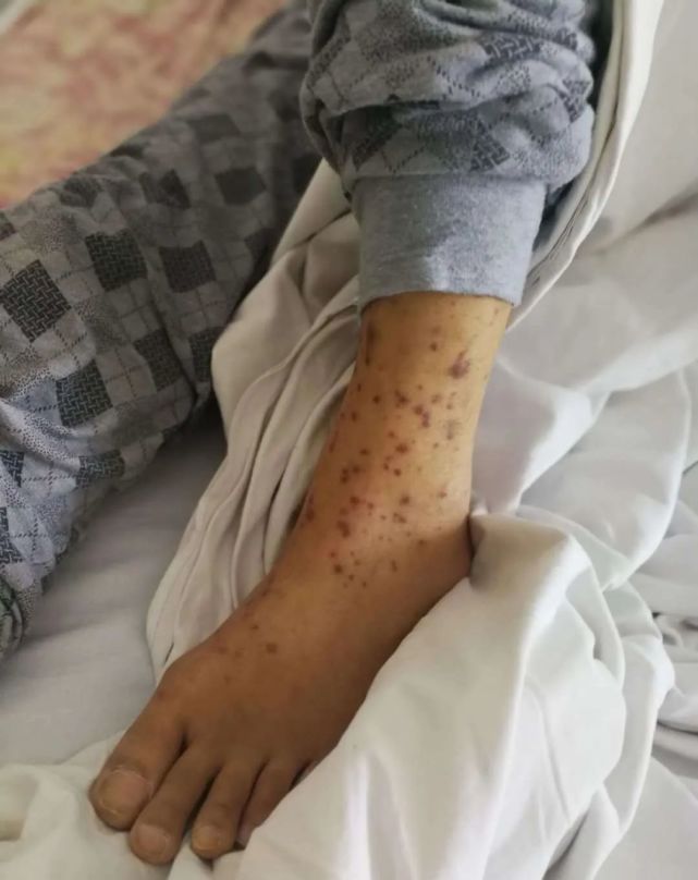 出血:白血病儿童相较于正常人来说,体内的血小板较少,质量也不够好