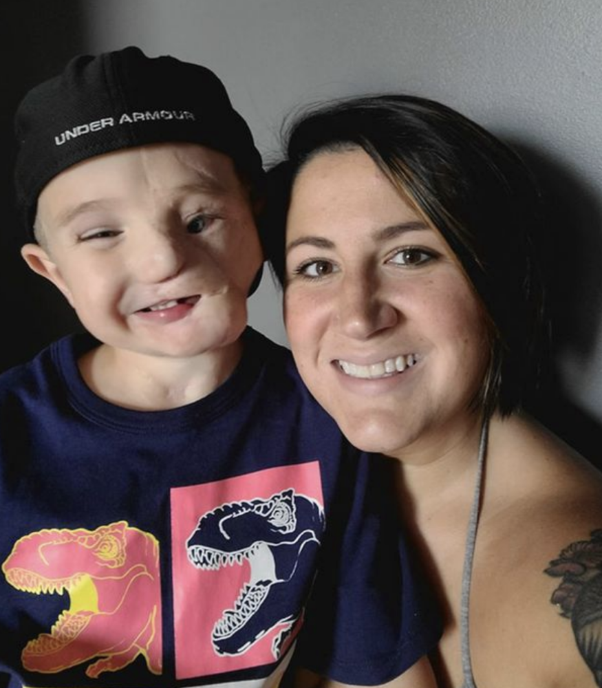 莱德·韦尔斯|美国小男孩被猎犬咬掉半张脸，如今长大被称为怪物